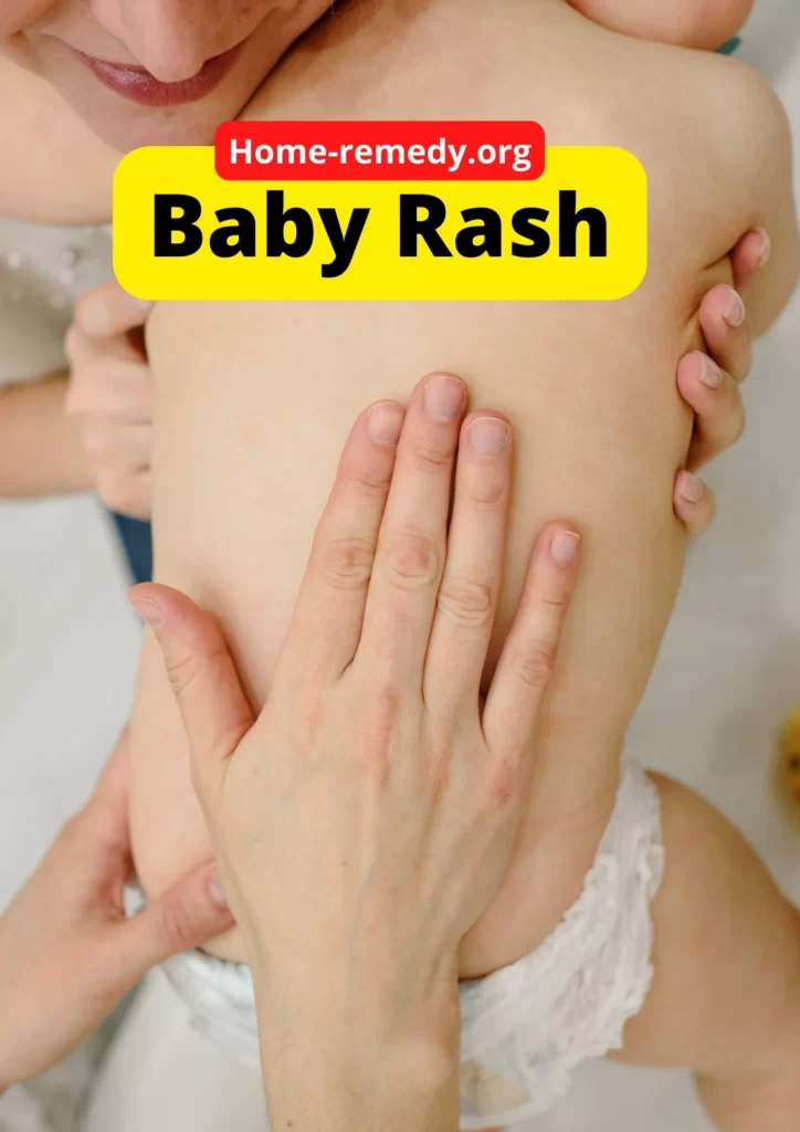 Home Remedies For Baby Rash On Body